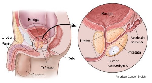A Próstata localiza-se na pelve. Ela fica abaixo da bexiga, envolvendo a uretra e a frente do reto.